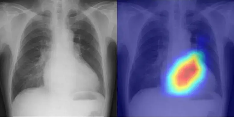 Esquerda: Radiografia de tórax Direita: Visualização dos fundamentos do julgamento da IA.